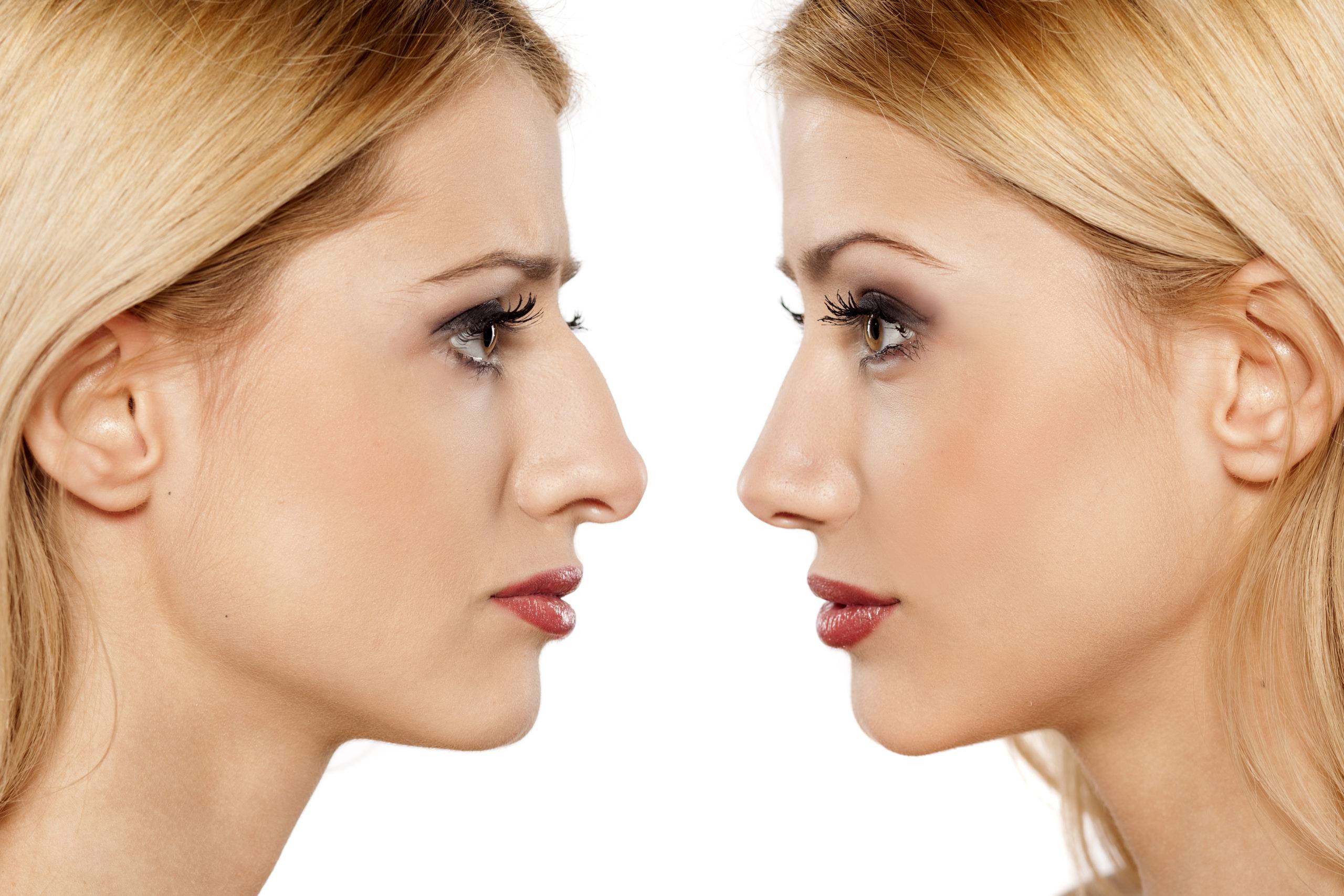 The Importance of Facial Harmony in Nasal Surgery